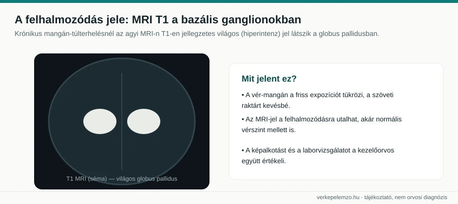 MRI T1 jel a bazális ganglionokban mangánnál